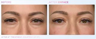 EMFACE Eyes Treatments Before & After in Edmonton