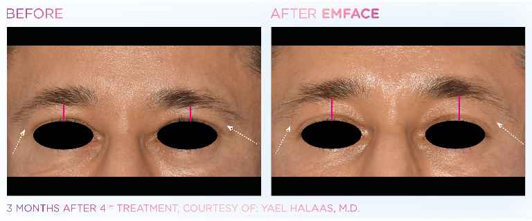 EMFACE Eyes Treatments Before & After in Edmonton