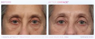 EMFACE Eyes Treatments Before & After in Edmonton