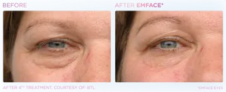 EMFACE Eyes Treatments Before & After in Edmonton