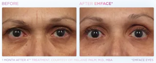 EMFACE Eyes Treatments Before & After in Edmonton