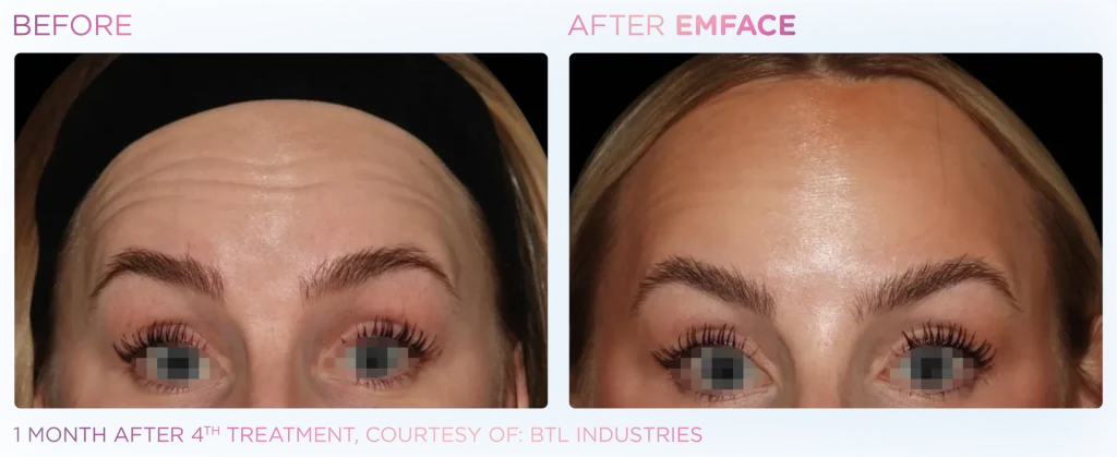 YOUTHFULYOU_EMFACE_FOREHEAD_B&A_EDMONTON_1
