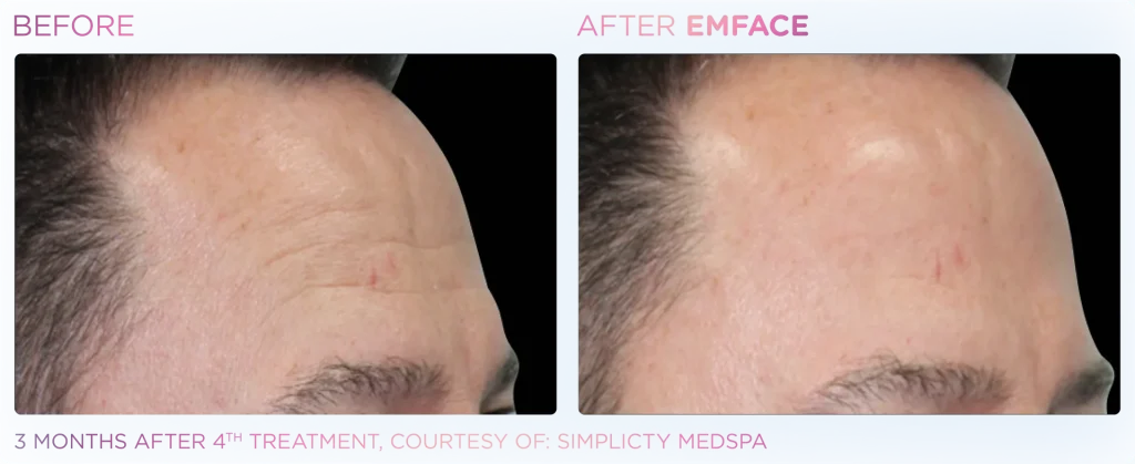 YOUTHFULYOU_EMFACE_FOREHEAD_B&A_EDMONTON_2