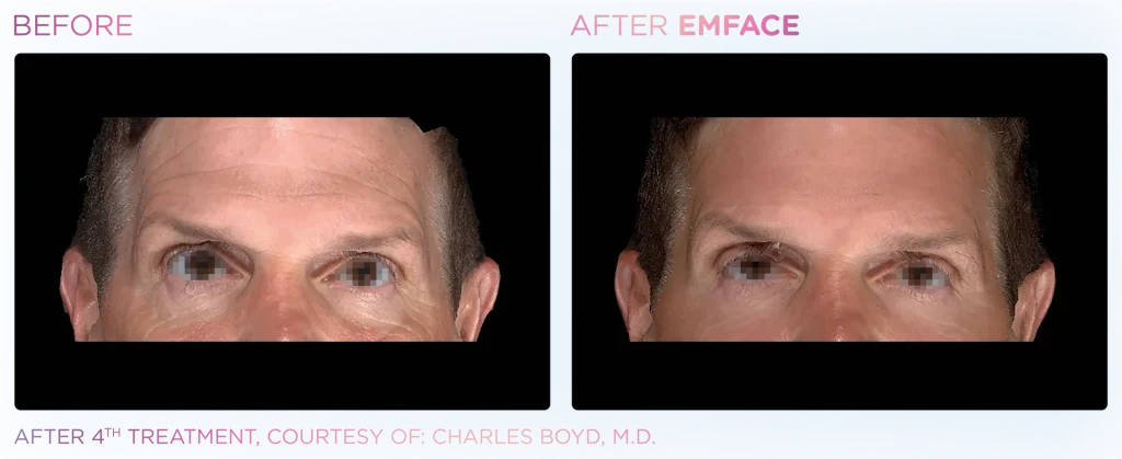 YOUTHFULYOU_EMFACE_FOREHEAD_B&A_EDMONTON_4