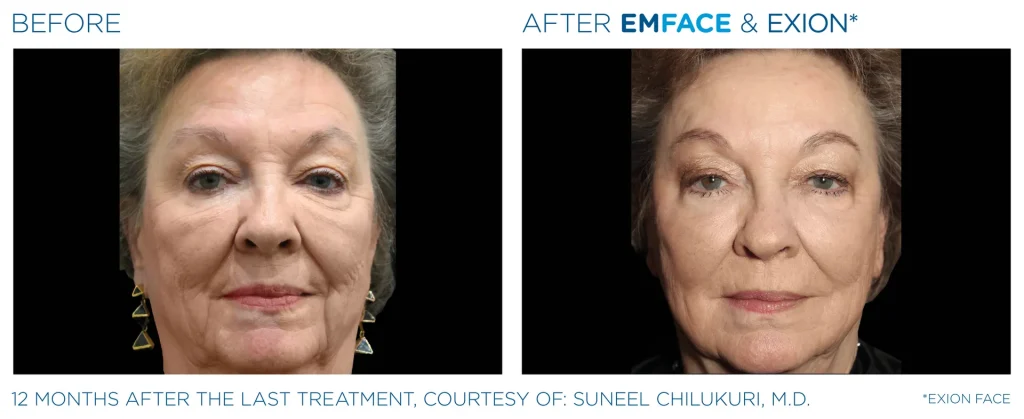 YOUTHFULYOU_EMFACE_FULL_B&A_EDMONTON_1
