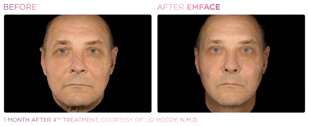 YOUTHFULYOU_EMFACE_FULL_B&A_EDMONTON_10