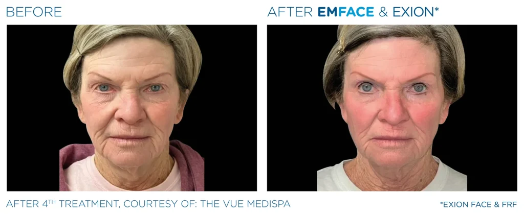 YOUTHFULYOU_EMFACE_FULL_B&A_EDMONTON_2