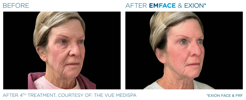 YOUTHFULYOU_EMFACE_FULL_B&A_EDMONTON_3