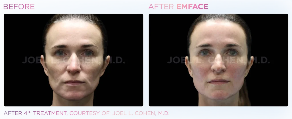 YOUTHFULYOU_EMFACE_FULL_B&A_EDMONTON_4