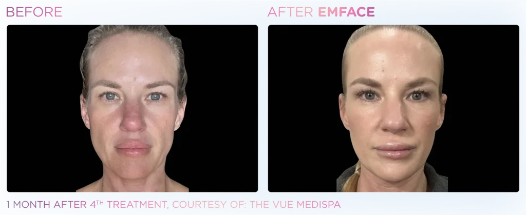 YOUTHFULYOU_EMFACE_FULL_B&A_EDMONTON_5