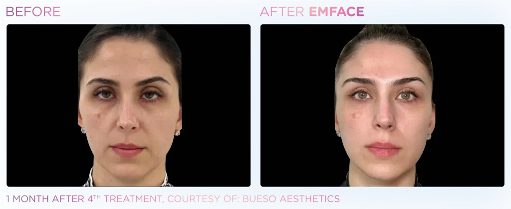 YOUTHFULYOU_EMFACE_FULL_B&A_EDMONTON_6