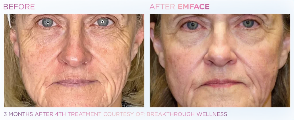 YOUTHFULYOU_EMFACE_FULL_B&A_EDMONTON_8