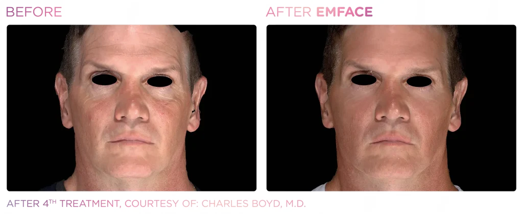 YOUTHFULYOU_EMFACE_FULL_B&A_EDMONTON_9