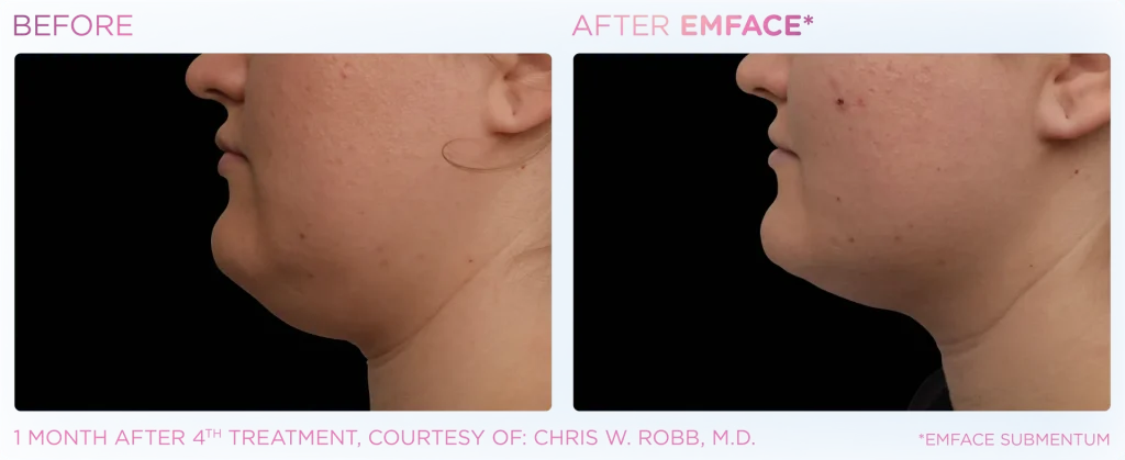 YOUTHFULYOU_EMFACE_SUBMENTUM_B&A_EDMONTON_2