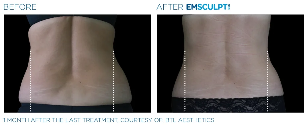 Before & After Emsculpt NEO Treatments near me in Edmonton