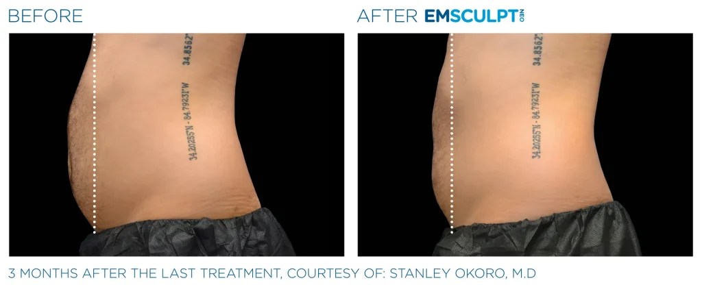 Before & After Emsculpt NEO Treatments near me in Edmonton