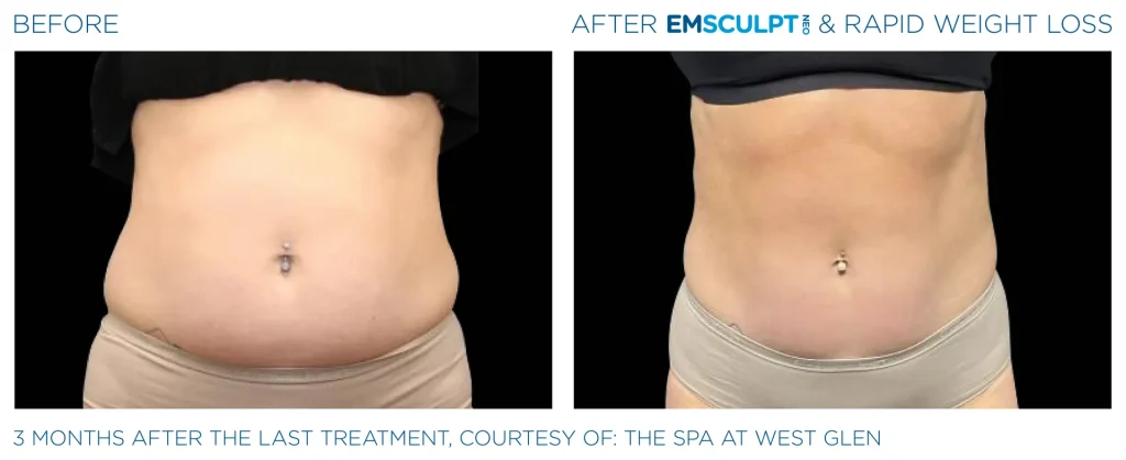 Before & After Emsculpt NEO Treatments near me in Edmonton