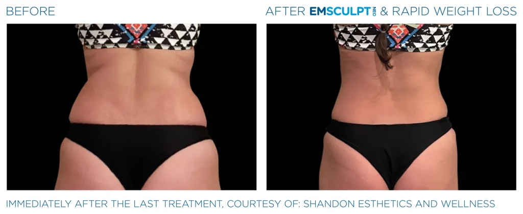 Before & After Emsculpt NEO Treatments near me in Edmonton