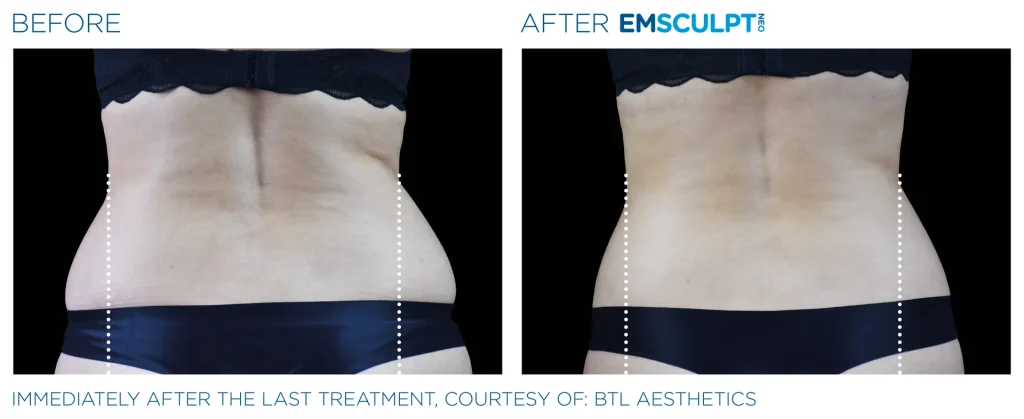 Before & After Emsculpt NEO Treatments near me in Edmonton