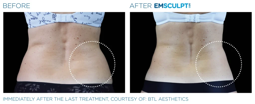 Before & After Emsculpt NEO Treatments near me in Edmonton