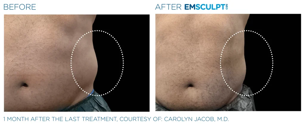 Before & After Emsculpt NEO Treatments near me in Edmonton