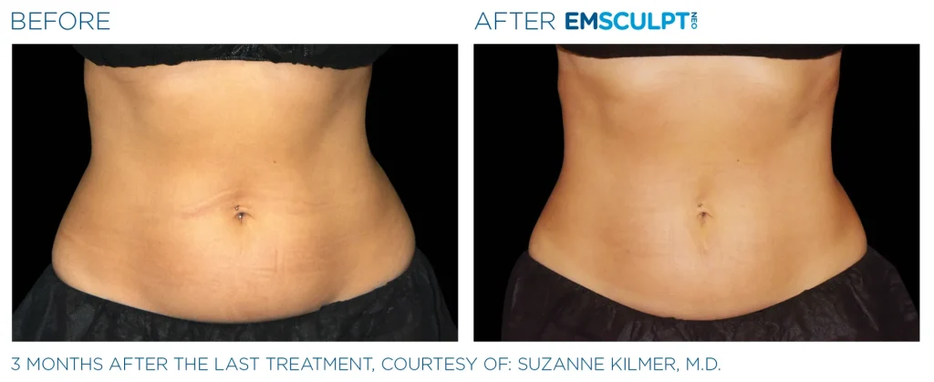 Before & After Emsculpt NEO Treatments near me in Edmonton
