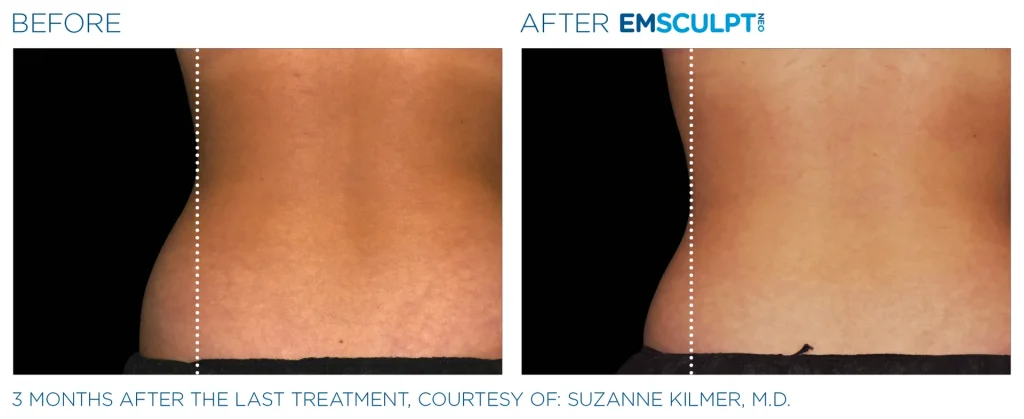 Before & After Emsculpt NEO Treatments near me in Edmonton