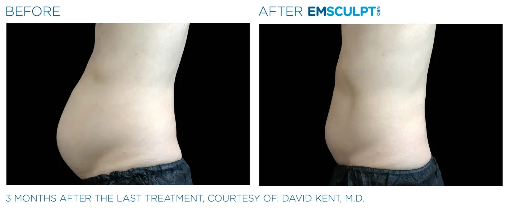 Before & After Emsculpt NEO Treatments near me in Edmonton