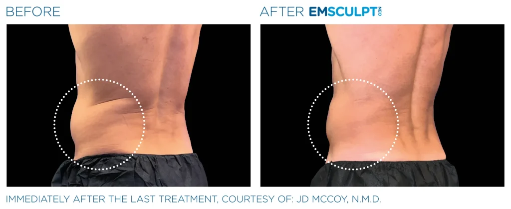 Before & After Emsculpt NEO Treatments near me in Edmonton