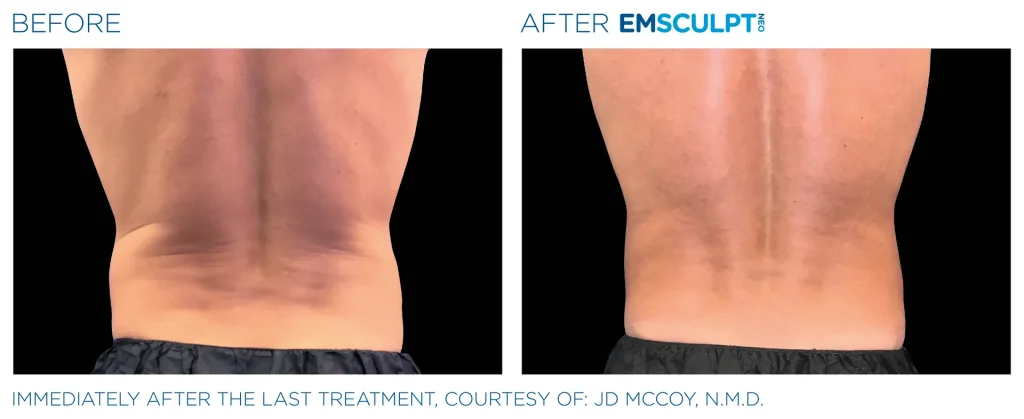 Before & After Emsculpt NEO Treatments near me in Edmonton