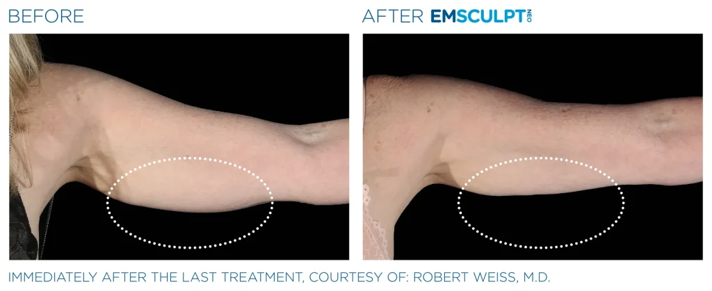 Before & After Emsculpt NEO Treatments near me in Edmonton