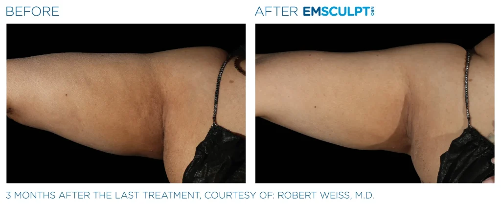 Before & After Emsculpt NEO Treatments near me in Edmonton