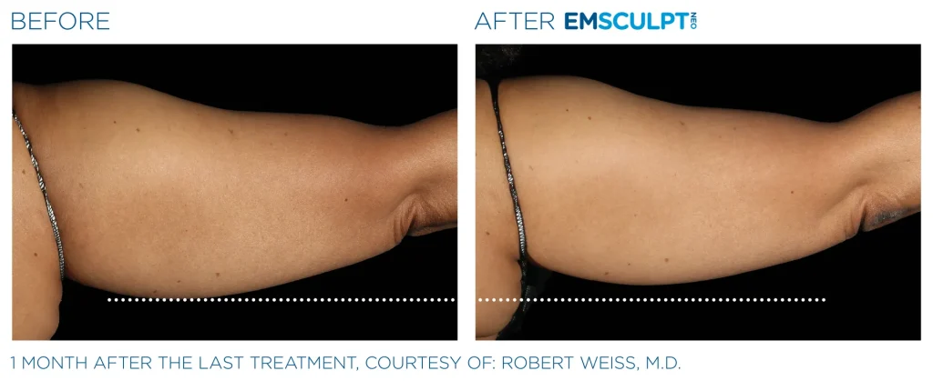 Before & After Emsculpt NEO Treatments near me in Edmonton