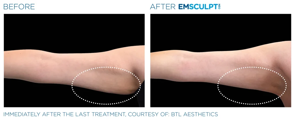 Before & After Emsculpt NEO Treatments near me in Edmonton