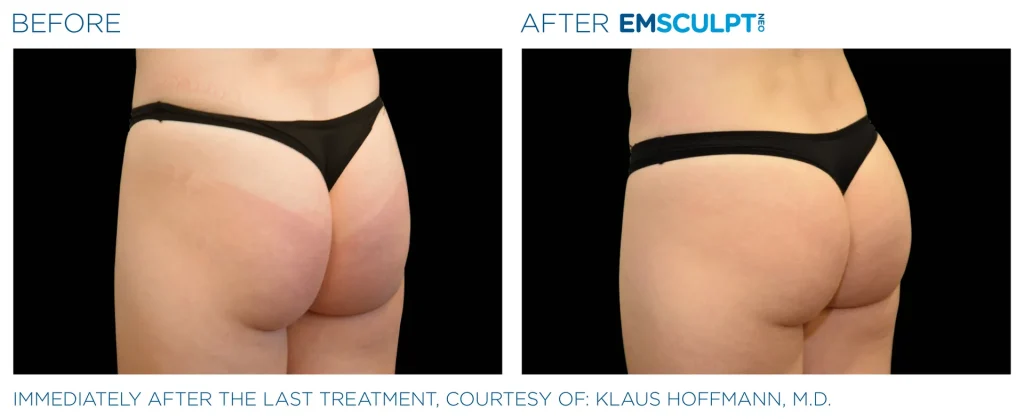 Before & After Emsculpt NEO Treatments near me in Edmonton