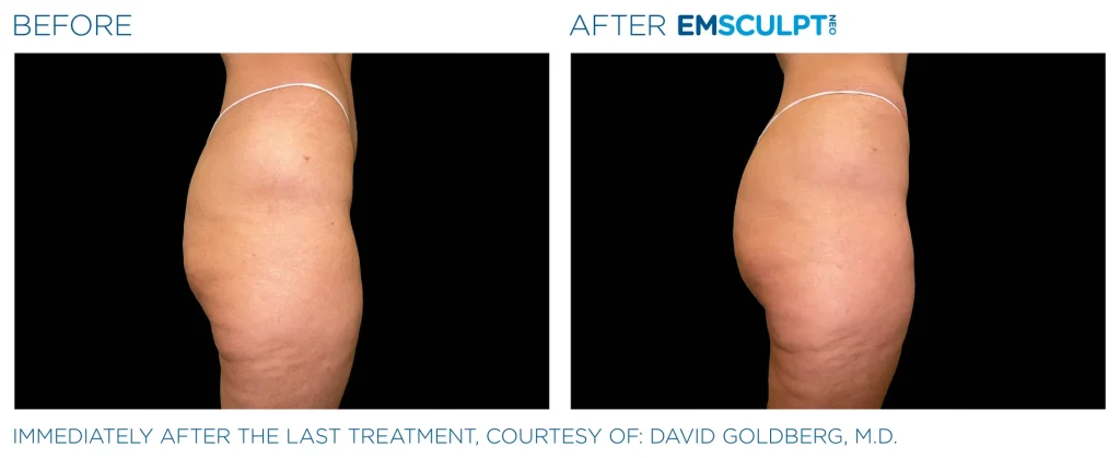 Before & After Emsculpt NEO Treatments near me in Edmonton