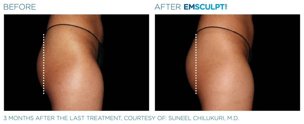 Before & After Emsculpt NEO Treatments near me in Edmonton