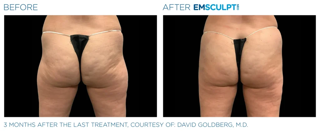 Before & After Emsculpt NEO Treatments near me in Edmonton
