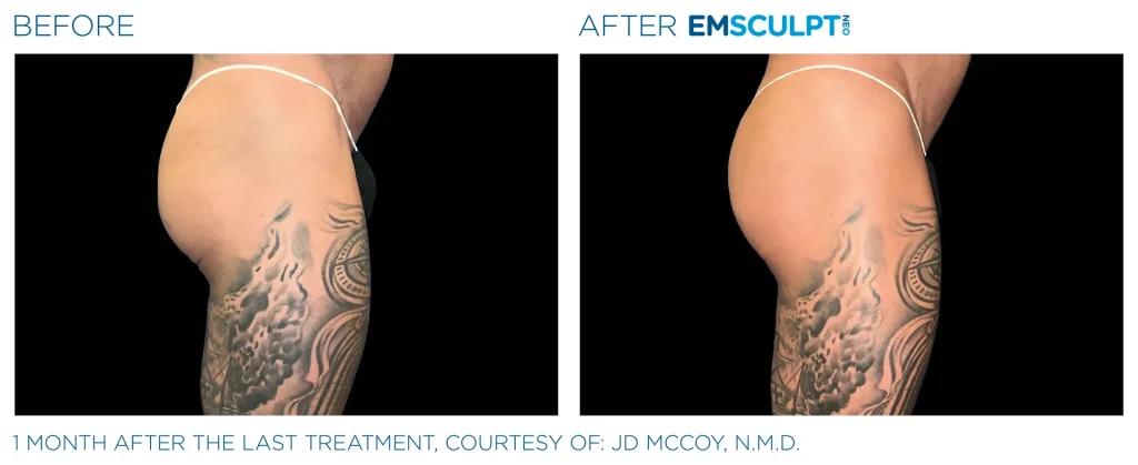 Before & After Emsculpt NEO Treatments near me in Edmonton