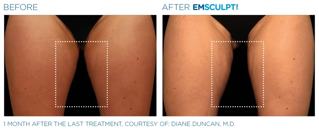 Before & After Emsculpt NEO Treatments near me in Edmonton