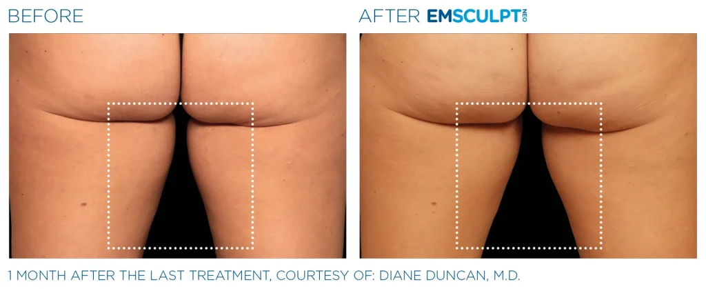 Before & After Emsculpt NEO Treatments near me in Edmonton