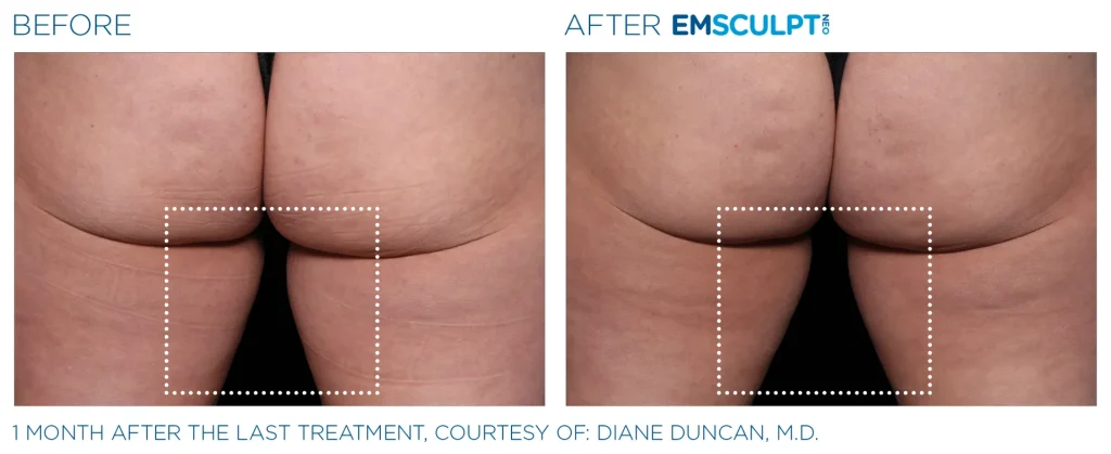 Before & After Emsculpt NEO Treatments near me in Edmonton