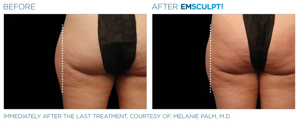 Before & After Emsculpt NEO Treatments near me in Edmonton