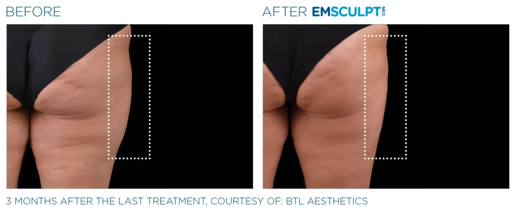 Before & After Emsculpt NEO Treatments near me in Edmonton