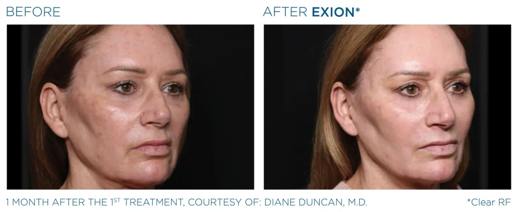 YOUTHFULYOU_EXION_CLEAR_B&A_EDMONTON_1