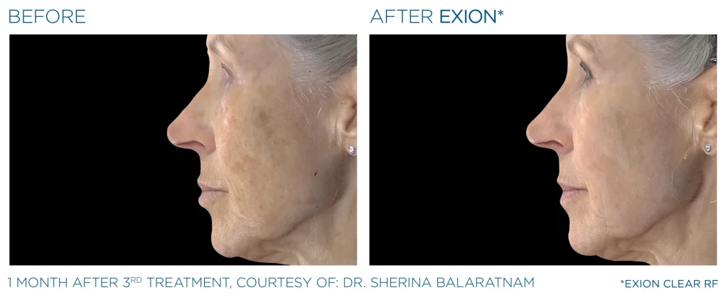 YOUTHFULYOU_EXION_CLEAR_B&A_EDMONTON_2