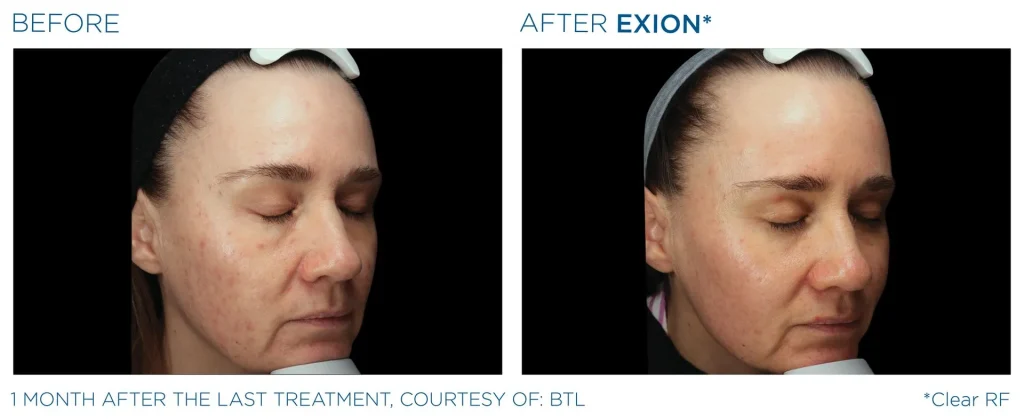 YOUTHFULYOU_EXION_CLEAR_B&A_EDMONTON_3