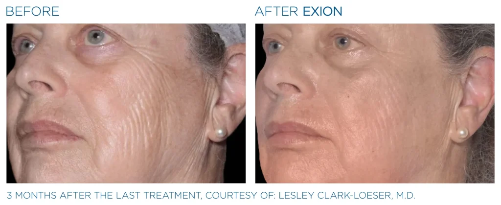 YOUTHFULYOU_EXION_FACE_B&A_EDMONTON_1