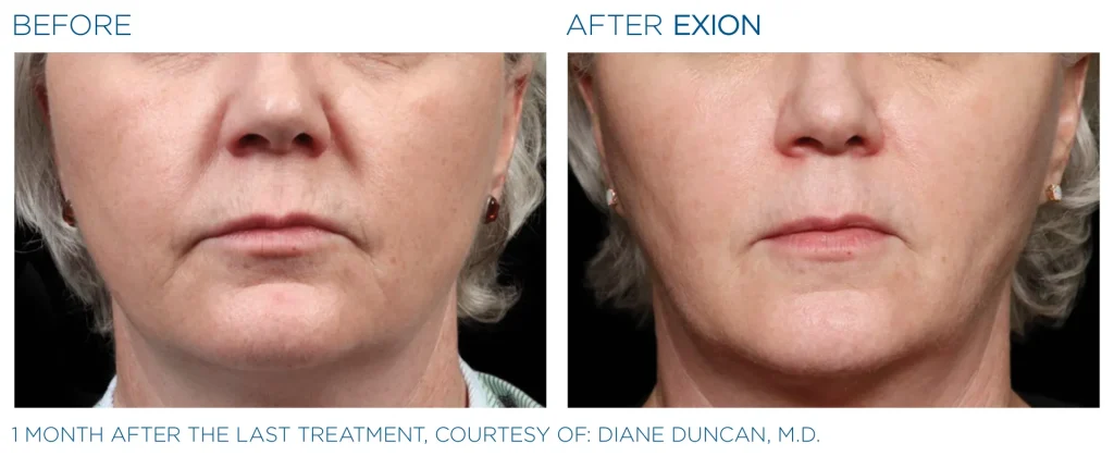 YOUTHFULYOU_EXION_FACE_B&A_EDMONTON_10