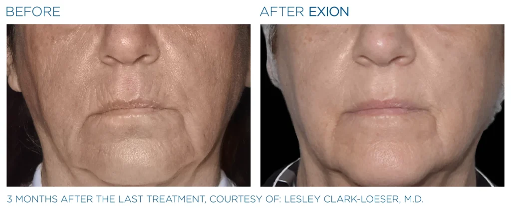 YOUTHFULYOU_EXION_FACE_B&A_EDMONTON_11